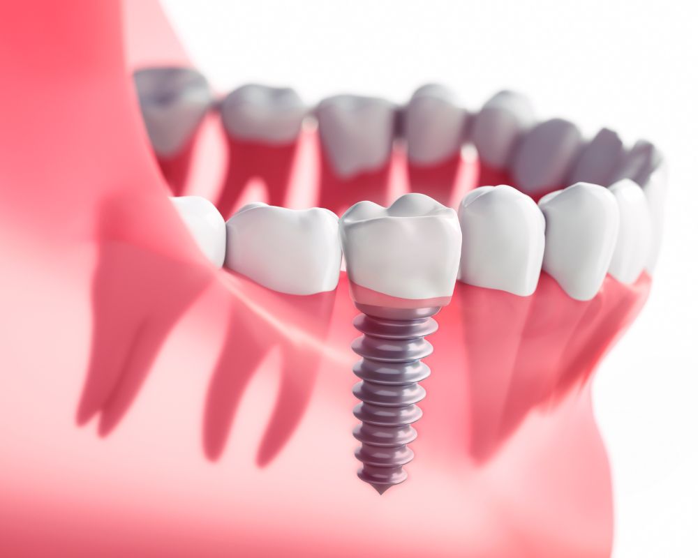 Implante dental Coquimbo